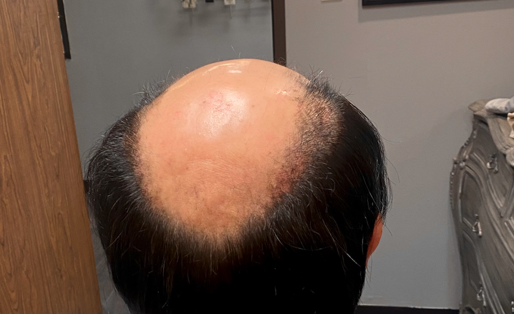 Hair restoration consult